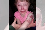 bite marks, school bus, 10 year old special needs child brutally bitten on arm while returning home in school bus, Special needs child