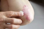 Skin disorders symptoms, Skin disorders news, five common skin disorders and their symptoms, Immune system