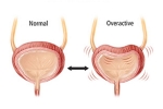 Overactive Bladder news, Overactive Bladder foods, here are some warning signs of an overactive bladder, Caf