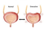 Overactive Bladder prevention, Overactive Bladder, here are some warning signs of an overactive bladder, Overactive bladder