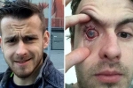 parasites eat man’s eye, contact lens safety, contact lens wearers beware man goes blind after parasites eat man s eye as he wore lenses in shower, Cornea
