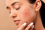 home remedies, acne, 10 ways to get rid of pimples at home, The nose