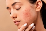 pimples, dermatologist, 10 ways to get rid of pimples at home, Sunscreen