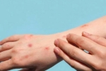 Monkeypox research, Monkeypox cases, study says that the symptoms of monkeypox are different from earlier, Monkey